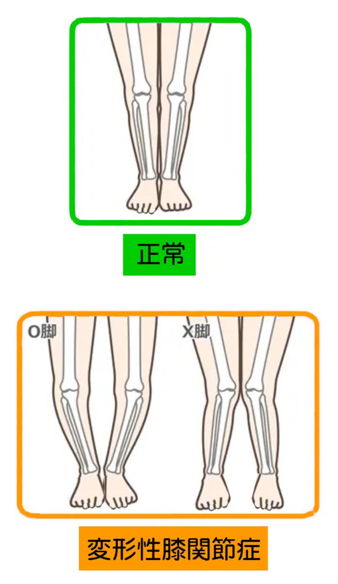 膝痛　変形性膝関節症Ｏ脚Ｘ脚